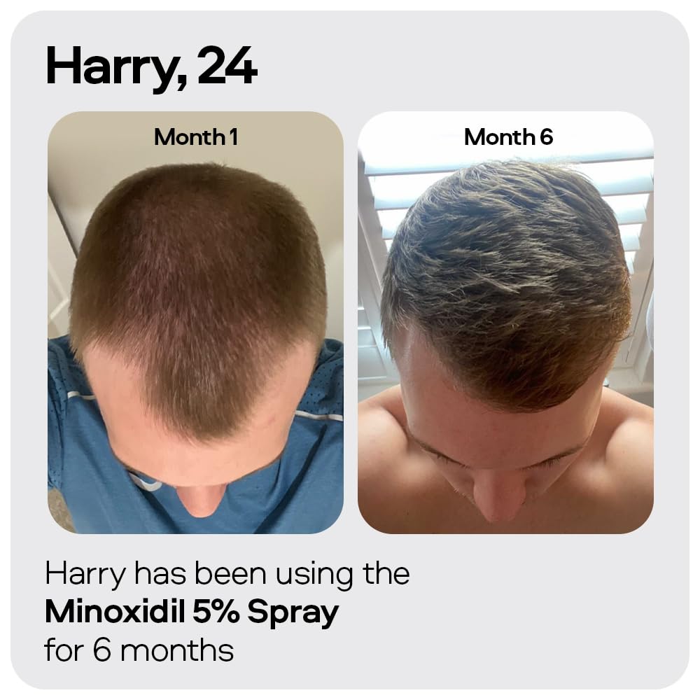 Sons Minoxidil 5% Cutaneous Solution for Men, Hair Regrowth & Thickener Formula, For Hair Loss & Thinning, Reactivates Shrunken Follicles, Precision Application System, 3 Month Supply Made in Europe