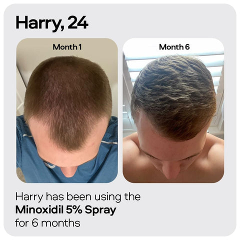 Sons Minoxidil 5% Cutaneous Solution for Men, Hair Regrowth & Thickener Formula, For Hair Loss & Thinning, Reactivates Shrunken Follicles, Precision Application System, 3 Month Supply Made in Europe