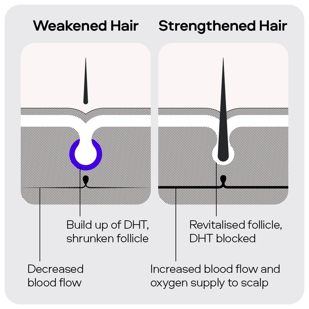 Sons Minoxidil 5% Cutaneous Solution for Men, Hair Regrowth & Thickener Formula, For Hair Loss & Thinning, Reactivates Shrunken Follicles, Precision Application System, 3 Month Supply Made in Europe
