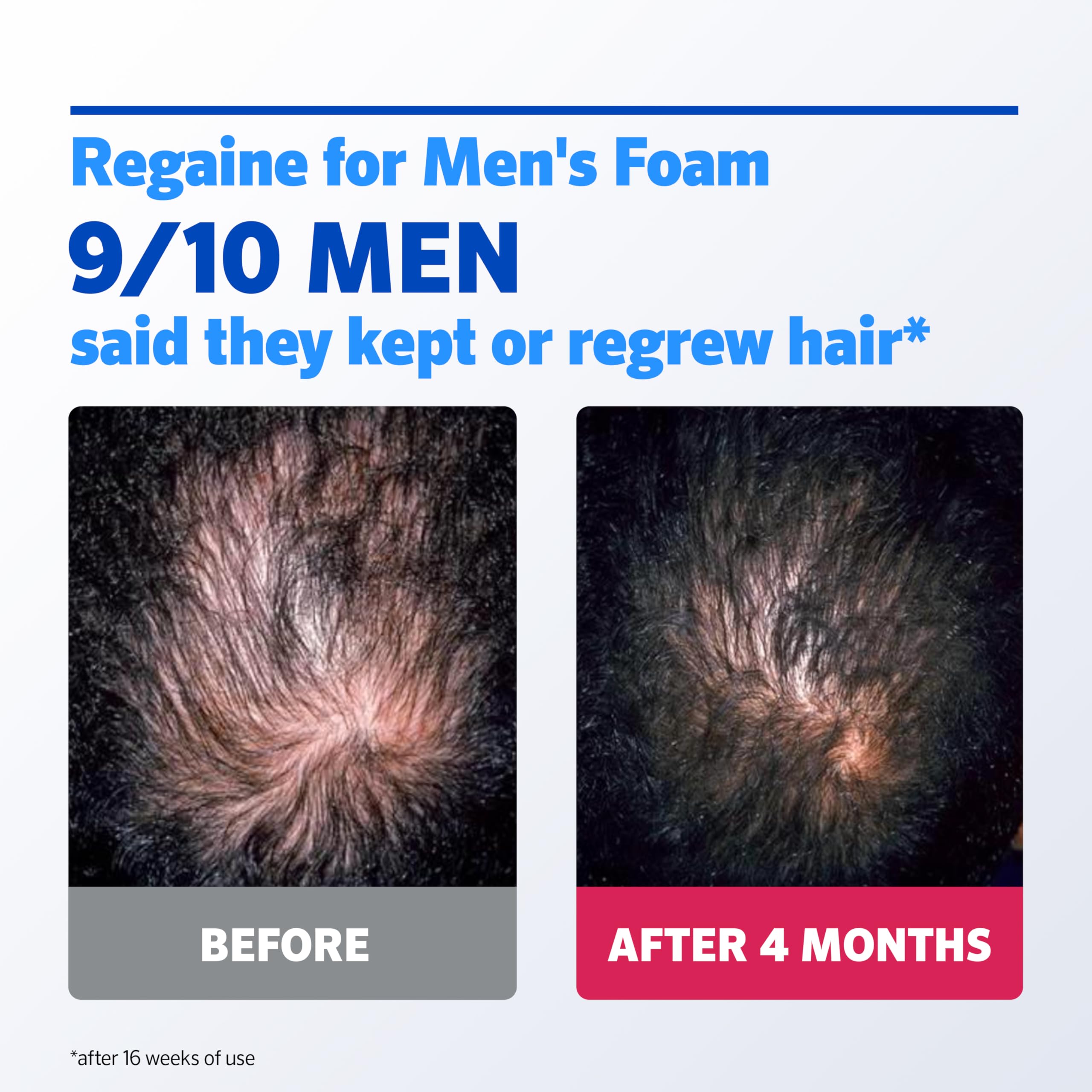Regaine For Men Extra Strength Foam - Scientifically Proven To Help Stop Hereditary Hair Loss - Minoxidil Foam for Hair Regrowth - (3 x 73ml), Packaging May Vary