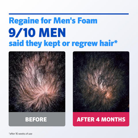 Regaine For Men Extra Strength Foam - Scientifically Proven To Help Stop Hereditary Hair Loss - Minoxidil Foam for Hair Regrowth - (3 x 73ml), Packaging May Vary