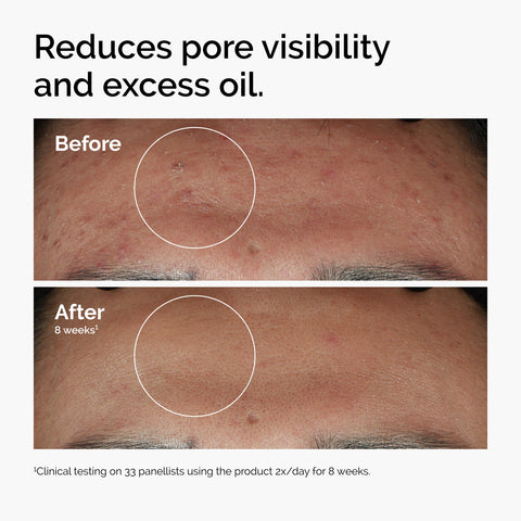 The Ordinary Niacinamide 10% + Zinc 1%, Brightening & Smoothing Serum for Blemish-Prone Skin, 30ml